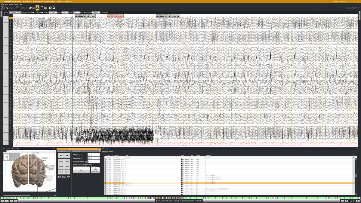 Arc EEG Cortical Stimulation