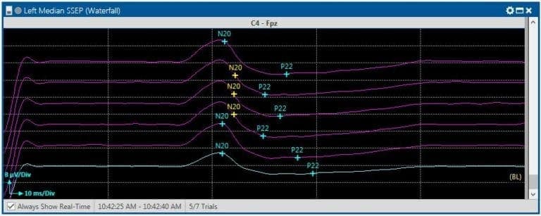IONM 워크플로우