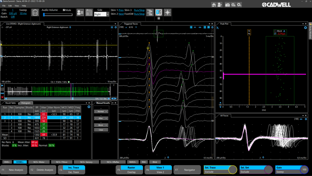 Single Fiber EMG (SFEMG)