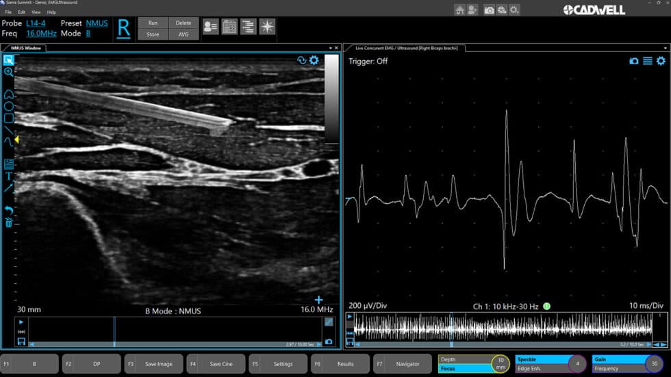 EMG/US Guidance+ 프로토콜 인터페이스